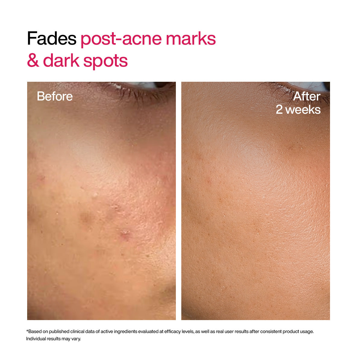 Advanced Dark Spot Correcting TXA Shot