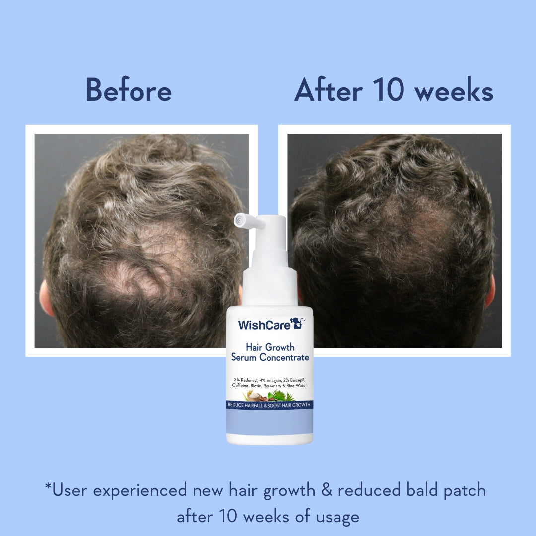 picture describing before and after images of using best hair growth serum in India