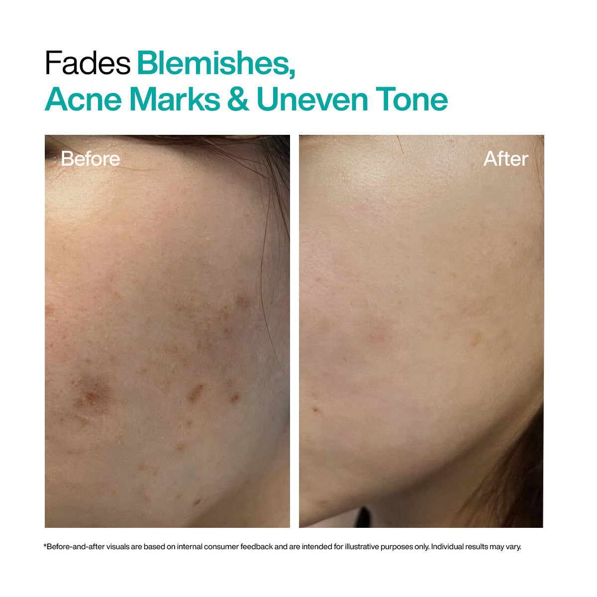 Before and after using WishCare 10% azelaic acid serum fades blemishes, pimple marks, dark spots and uneven skin tone