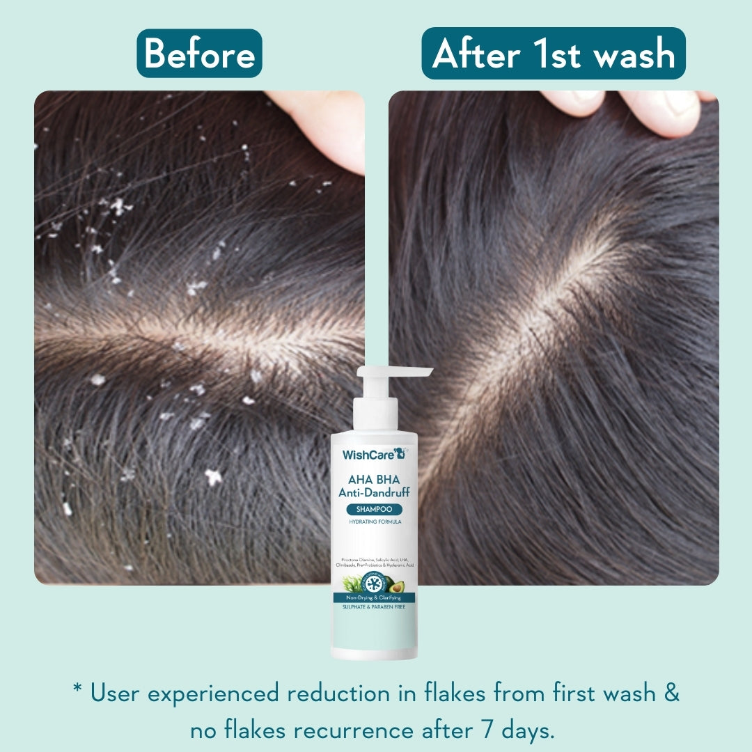 before and after images showing how this is effective to reduce dry and flaky scalp