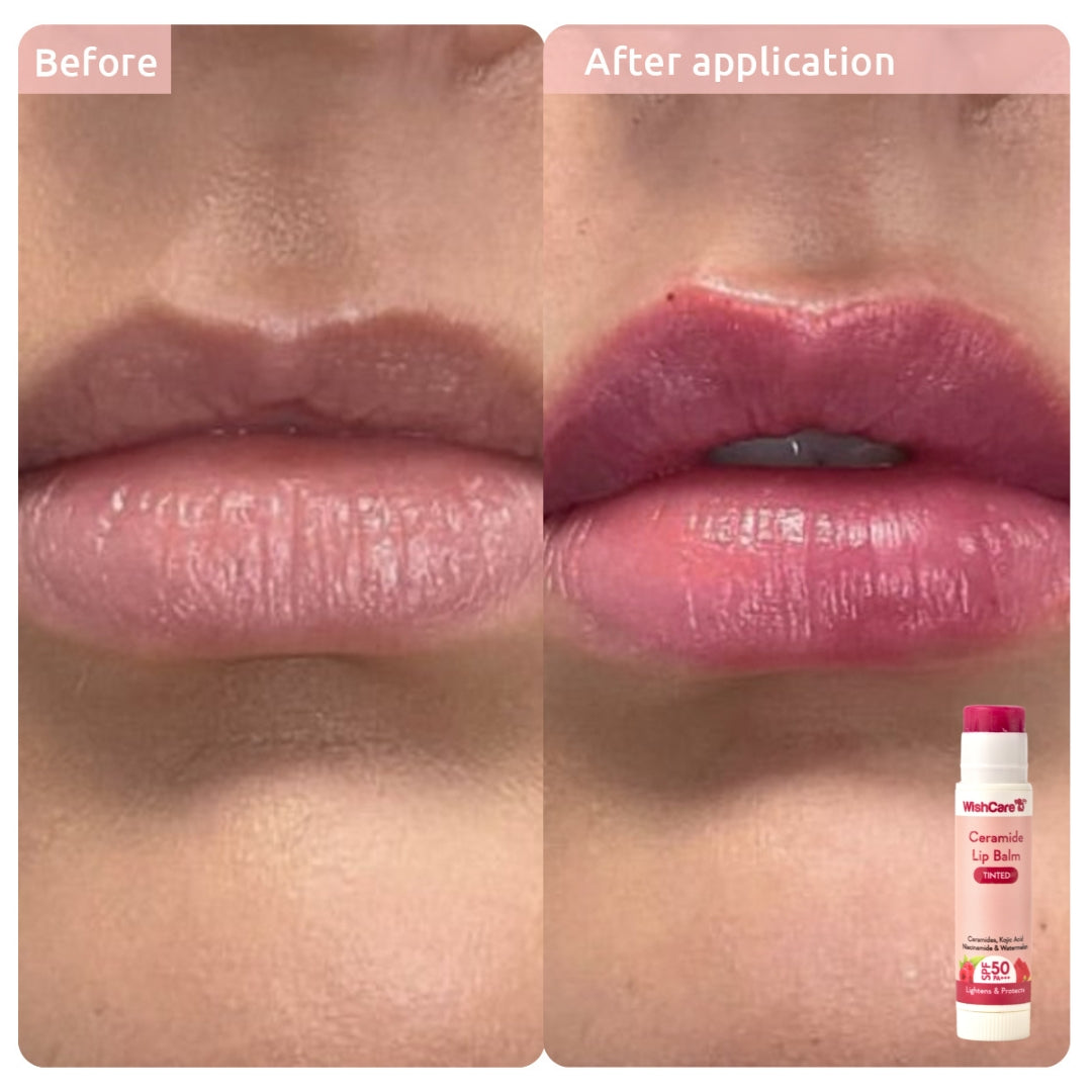 before and after images showing how this kojic acid lip balm helps to reduce lip pigmentation