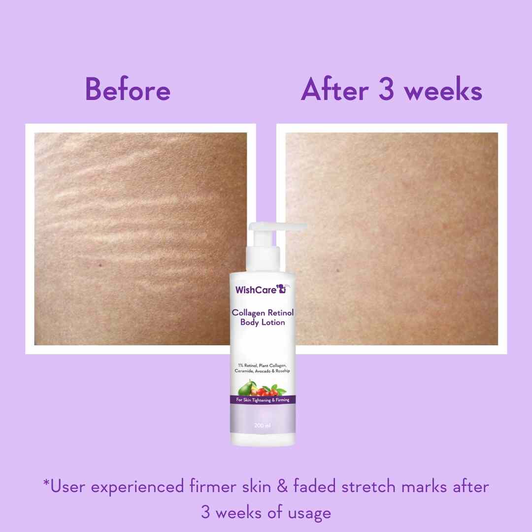 before and after images of using skin firming cream