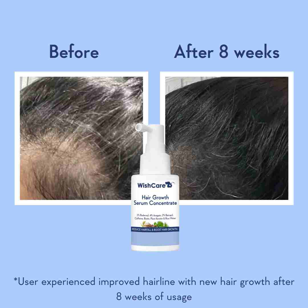 picture describing before and after images of using best hair growth serum in India
