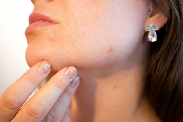 Your Complete Guide On How To Get Rid Of Acne | WishCare