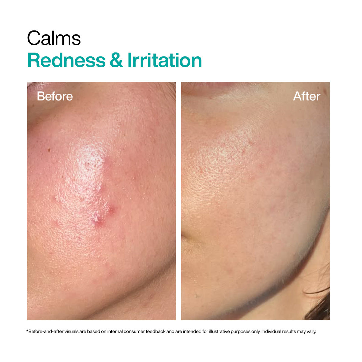 Before and after WishCare azelaic acid 10% calms redness and irritation from red pimples on face