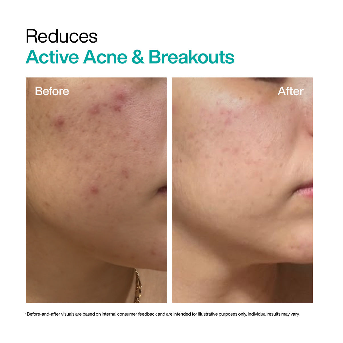 Acne & Oil Control Duo