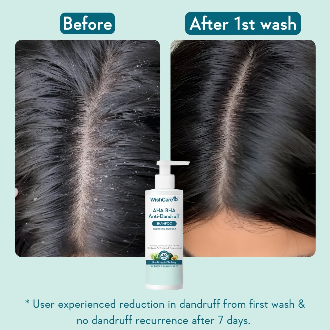 Before after image of anti dandruff shampoo