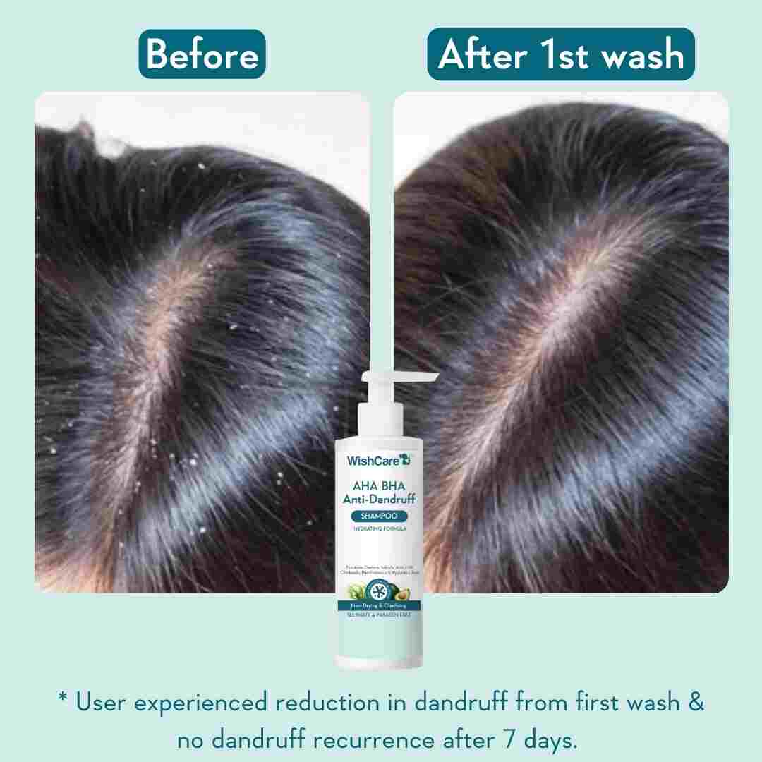 before and after images showing how this is effective to reduce dandruff from first wash