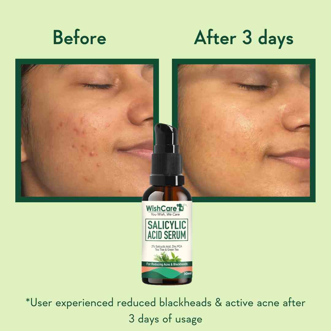 picture describing before and after images of using best skin serum for oily skin
