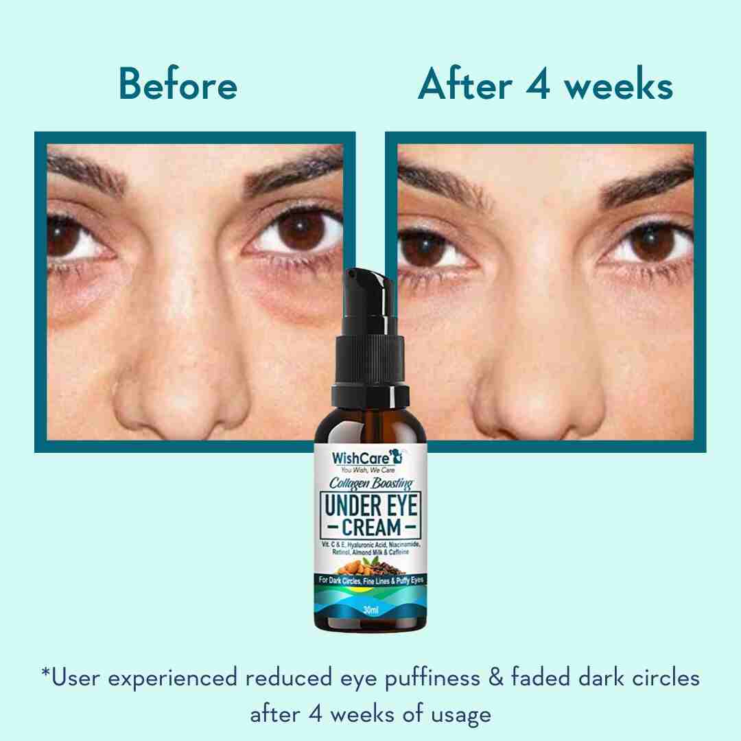 before and after image using best under eye cream for dark circles