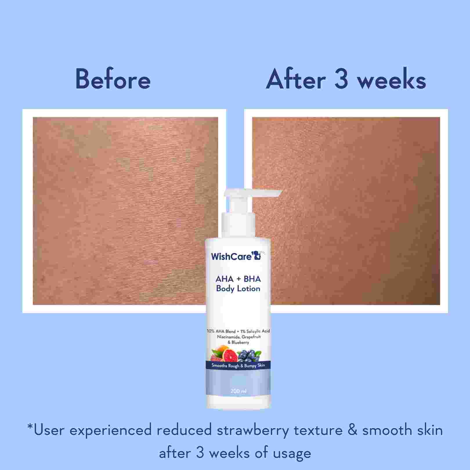 picture about how aha bha body lotion works on strawberry legs and body acne