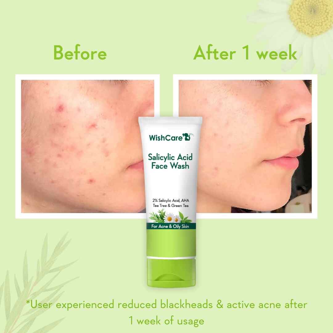 before and after images showing the difference after using the best face wash for oily skin